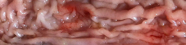 Zgrubiała śluzówka dalszej części jelita cienkiego