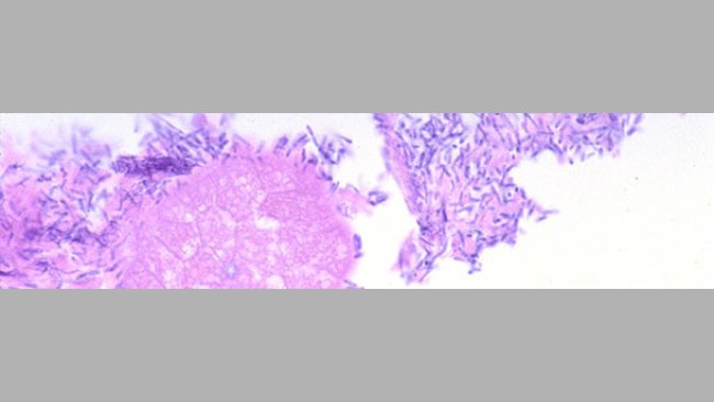Small intestine of a piglet with diarrhea associated with Clostridium perfringens type A infection