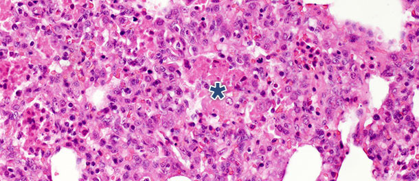 Intraalveolar necrotic debris, and inflammatory cell accumulation (asterisk) in the lung tissue at 10 days PI with PRRSV Type 1 subtype 1 isolate
