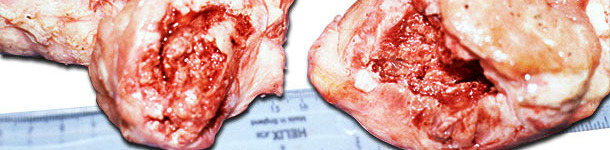 Entire head of the femur fractured at or below the epiphysis showing swelling around fracture site due to periostitis