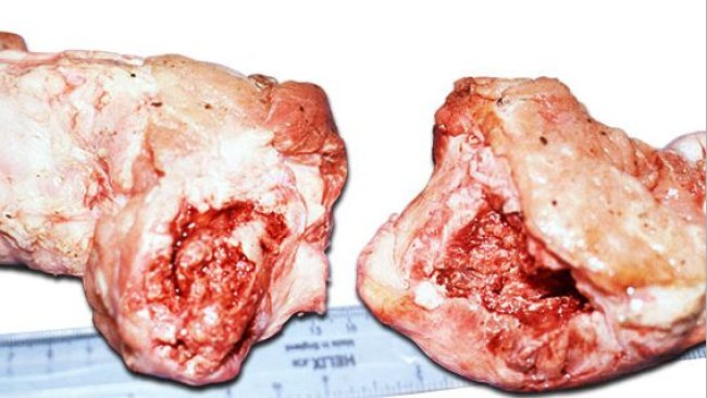 Entire head of the femur fractured at or below the epiphysis showing swelling around fracture site due to periostitis