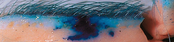 Needle-free injection technology improves the dispersion of vaccines throughout the tissue