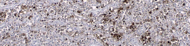 Antygen PCV2 wykryty w wyniku badania immunohistochemicznego