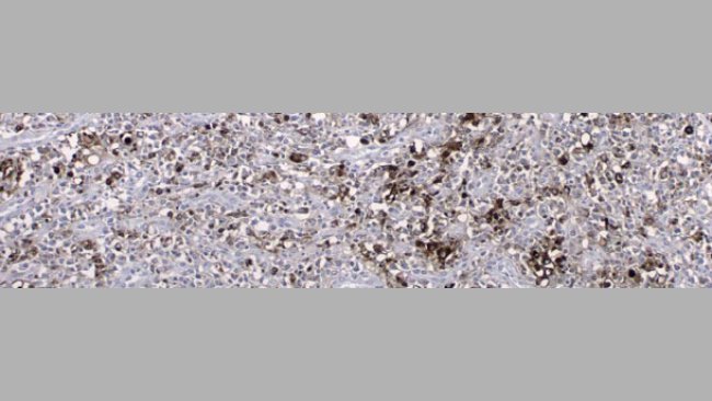 Antygen PCV2 wykryty w wyniku badania immunohistochemicznego