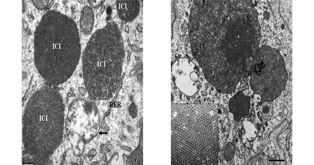Fotografia z mikroskopu elektronowego przedstawiająca węzeł chłonny świni chorej na uogólniona postać cirkowirozy (PCV2-SD). Uwagę zwraca obecność wewnątrzplazmatycznych ciałek wtrętowych (ICI)
