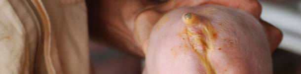 Biegunka wywołana przez E. coli (dzięki uprzejmości dr Hectora Pattullo)