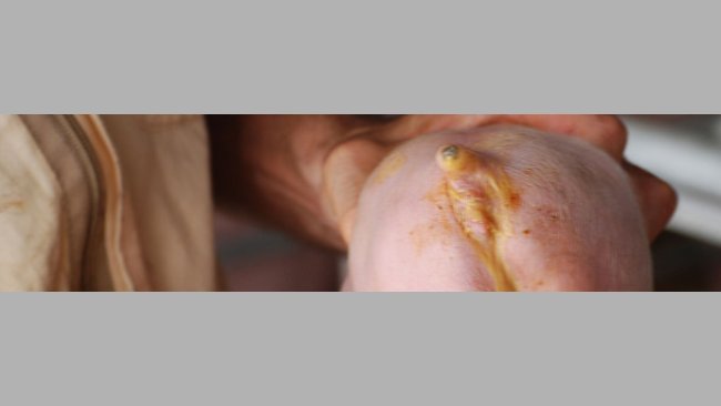 Biegunka wywołana przez E. coli (dzięki uprzejmości dr Hectora Pattullo)