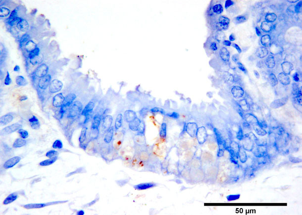 Immunohistochemiczne barwienie antygenu PCV2b w zmianach martwicowych trofoblastu.