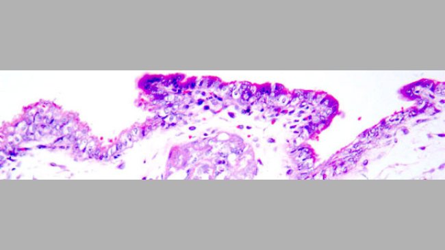 Martwica skrzepowa trofoblastu. Barwienie hematoksyliną i eozyną.