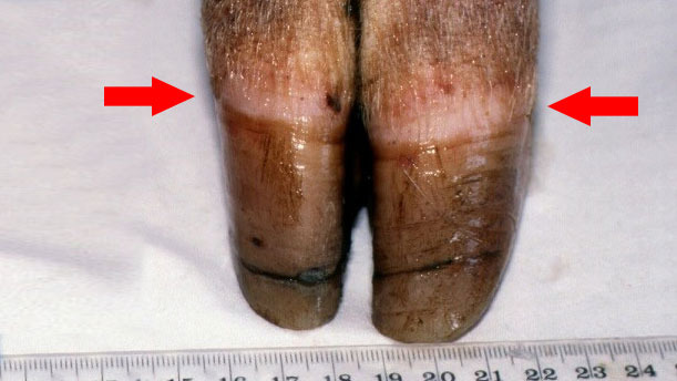 <p>Ryc 1. Obw&oacute;dka koronki [strzałka]. Widoczny jest nier&oacute;wny wzrost i pęknięcia rogu.</p>
