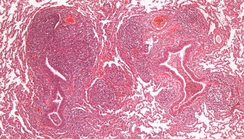 Ryc. 2:&nbsp;Rozrost tkanki limfatycznej okołooskrzelowej wywołany przez M. hyopneumoniae.
