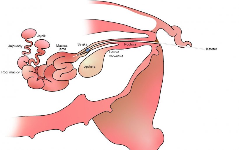 Ryc. 1. W przypadku inseminacji zaszyjkowej nasienie osadza się w jamie&nbsp;macicy, poza szyjką macicy.
