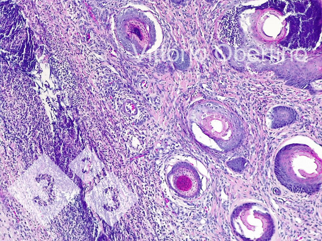 Rysunek 8. Pępek. Miejscowo rozległy obszar sk&oacute;ry złożony z fibroplazji z aktywowanymi fibroblastami i licznymi niedojrzałymi małymi naczyniami (nowo utworzona ziarnina), wieloogniskowy naciek zapalny z przewagą lymphoplasmacellular cells; in some vascular structures there is a granulocytic inflammatory infiltrate surrounding the vessel wall and focally infiltrating it (leukocytoclastic vasculitis).

