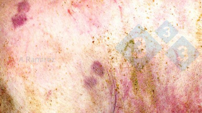 Fot. 1. Niemal patognomoniczna zmiana skórna w kształcie rombu.