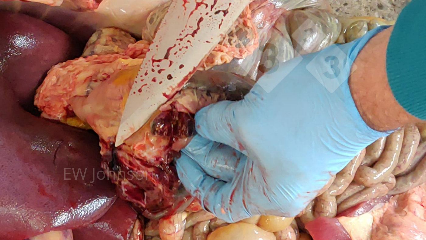 <p>Fot. 2. Wybroczyny i martwica w węźle żołądkowo-wątrobowym</p>
