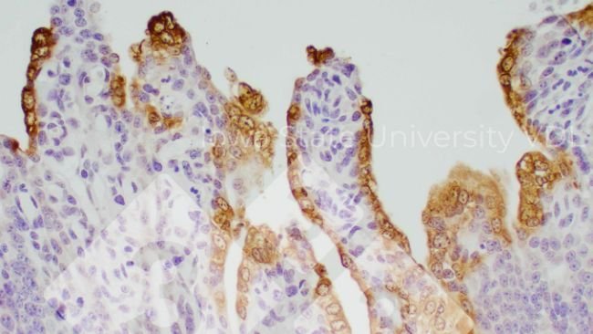 Zdjęcie 1.Barwienie  IHC  jelita cienkiego zainfekowanego PEDV Źródło: Iowa State University VDL.