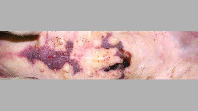 Accumulation of fluid beneath the skin in the sternum area