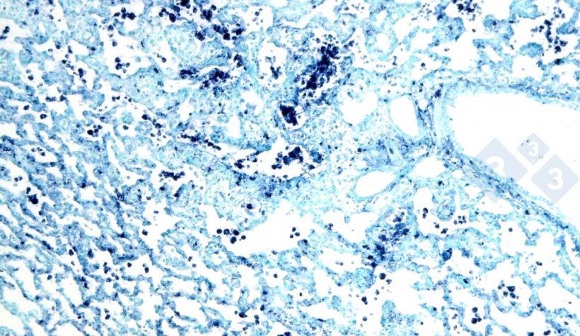Ryc. 4. Hybrydyzacja in situ w celu wykrycia cirkowirusa świń 2 (PCV-2) w płucach dotkniętych śr&oacute;dmiąższowym zapaleniem płuc.
