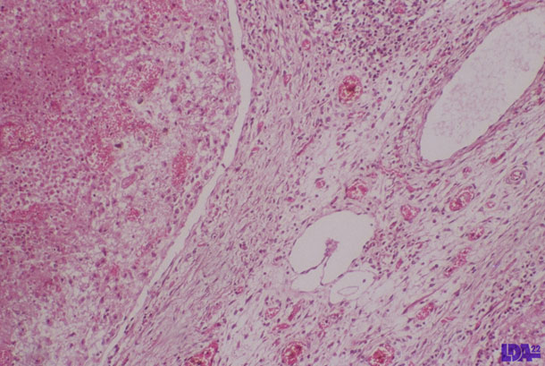 Lymph node necrosis on PCV2 infected piglet