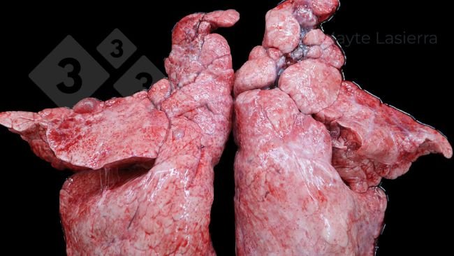 Zapalenie opłucnej doczaszkowej