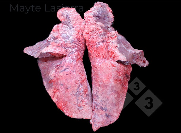 <p>Proces oskrzelowo-płucny</p>
