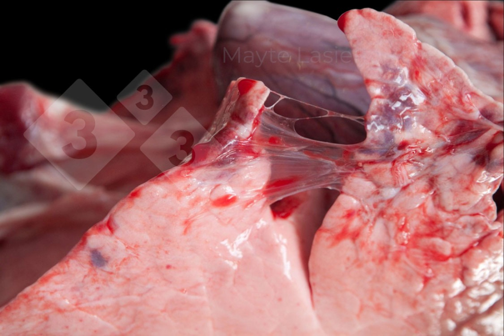 <p>Zapalenie opłucnej doczaszkowej</p>
