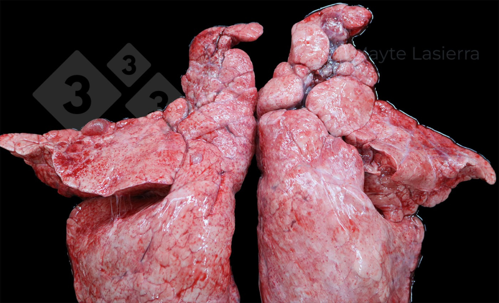 <p>Zapalenie opłucnej doczaszkowej</p>
