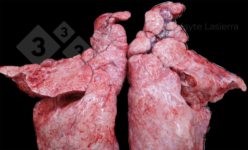 Zapalenie opłucnej doczaszkowej
