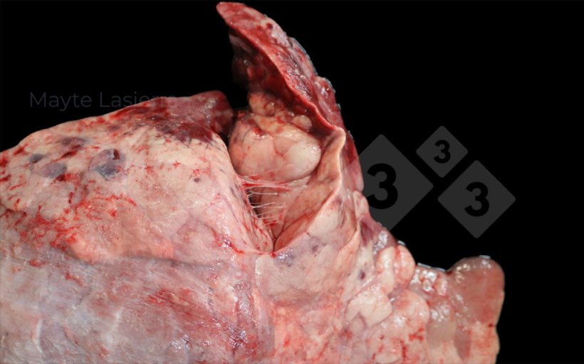 Zapalenie opłucnej doczaszkowej
