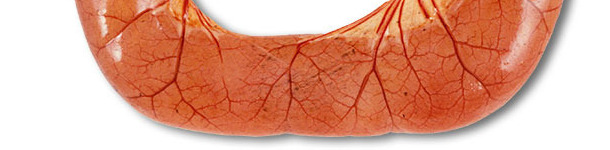 W badaniu sekcyjnym przypadków biegunki ETEC przeważnie stwierdza się rozszerzone, przekrwione pętle jelita cienkiego wypełnione wodnistą żółtą treścią