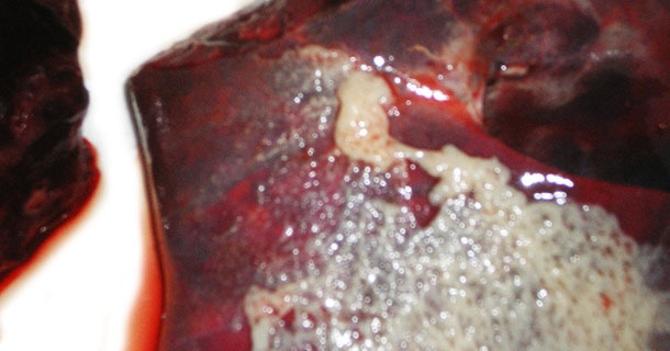 Acute App affected lungs with bread and butter pleurisy