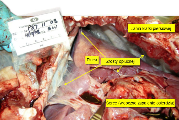 Pericarditis